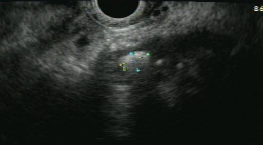 Alternative tests for early CP Endoscopic ultrasound High sensitivity (80%)