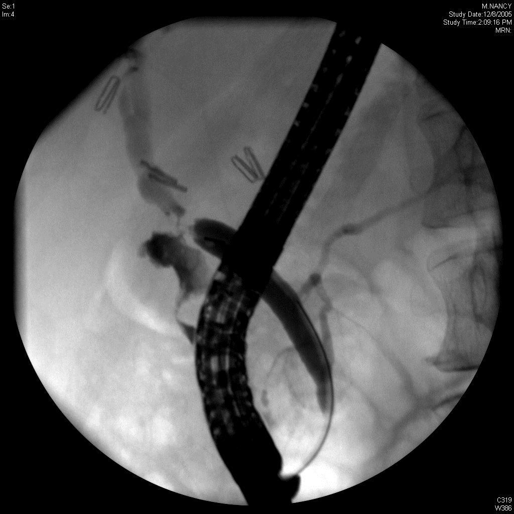 Post-Cholecystectomy Stricture