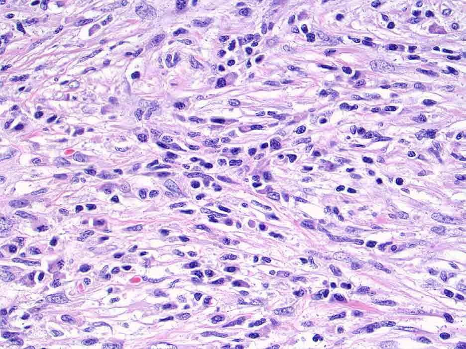Plasma-cell rich storiform fibrosis (