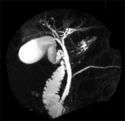 Cholangiogram : MRCP Reconstruction bile duct anatomy by