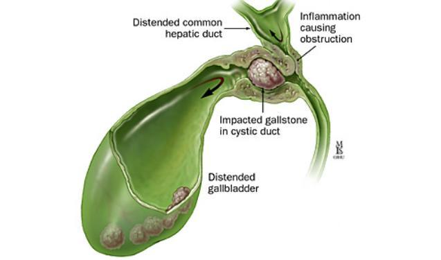 Merizzi s syndrome Sequelae or complication Acute cholecystitis Gangrenous cholecystitis Gallbladder perforation Empyema gallbladder Emphysematous