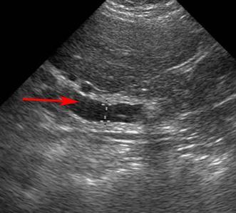 Investigation Ultrasonography Commonly the first test GS or CBD stone A dilated CBD (>8 mm in
