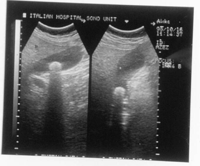 Investigation : US Abdominal ultrasound Ultrasound is initial
