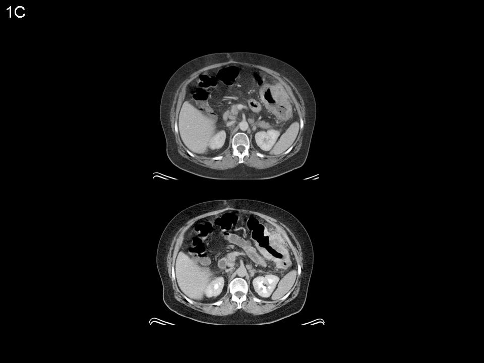 Figure 1C: Corresponding single-phase CT scan (acquired during