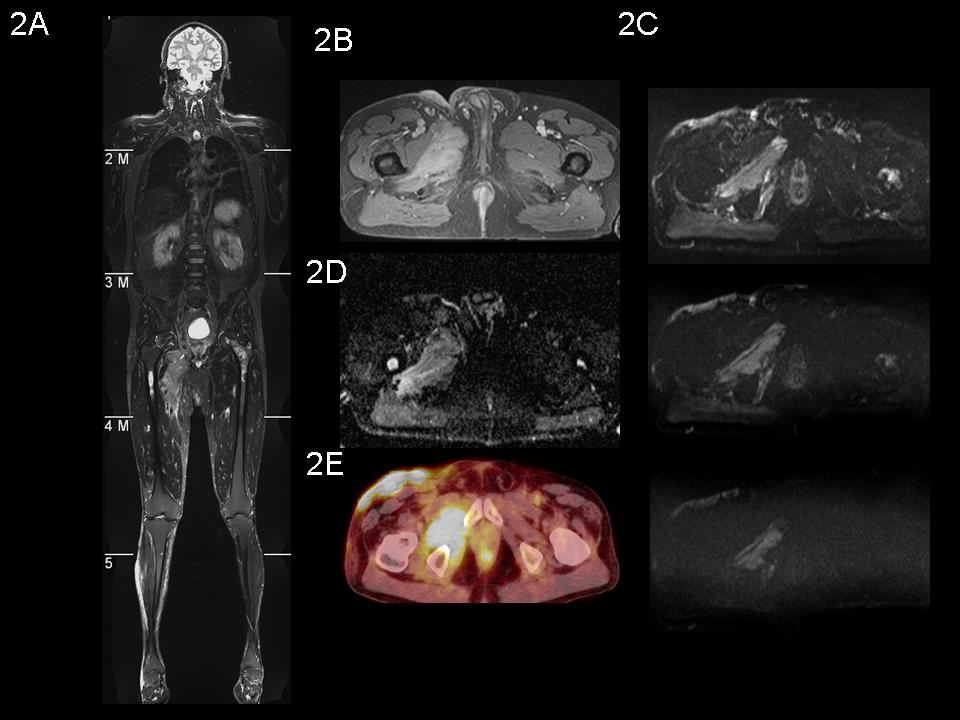 Case 2: Non-Hodgkin Lymphoma In this case, the results of PET-CT and DWI examination in a male patient with a non- Hodgkin lymphoma are shown.