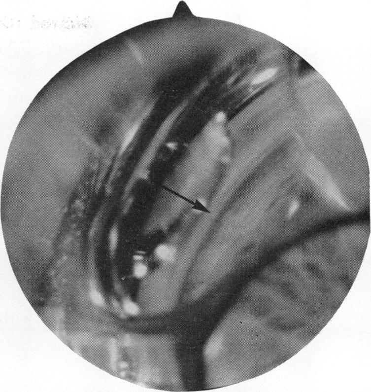 (Cases 2, 3, and 4), in which the intraocular pressure remained normal. FIG. 3 Case 2. Angle recession involving entire sector FIG.