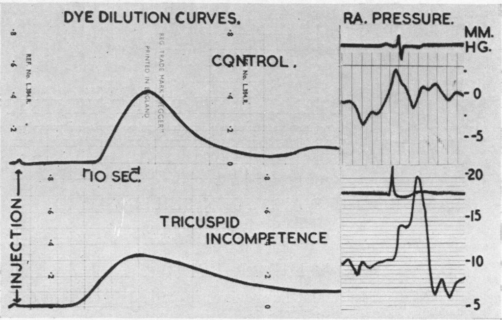 2 2'KORNER AND SHILLINGFORD DYE DILUTION CURVES. ta. t PRESSURE. ~ ~ ~ ~ tl 1...~~~~~~~~~G CW,rROL.. t-1 SE..... o TRICUSPID...15 INCOMP4ETENCE.