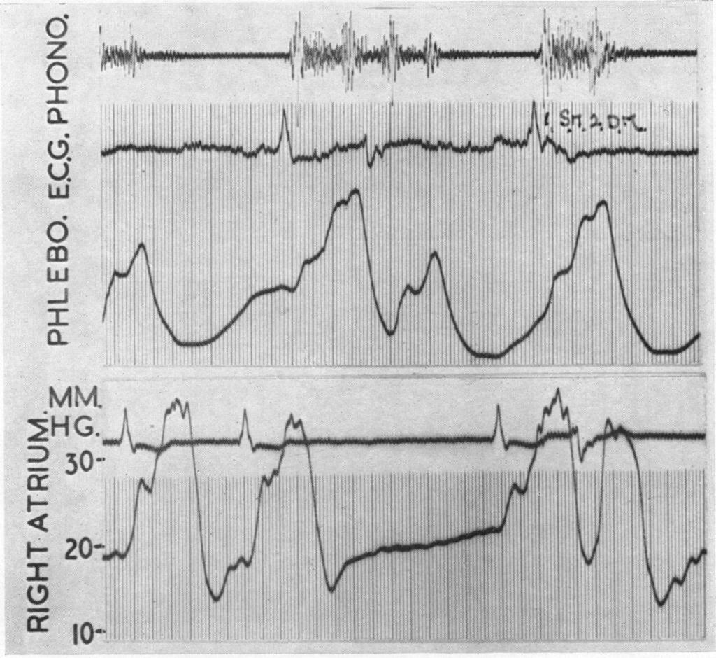 ~tl 44KORNER AND SHILLINGFORD minute. In this case exercise did not significantly change the forward cardiac output although the right ventricular output was greatly increased. Clinical Observations.