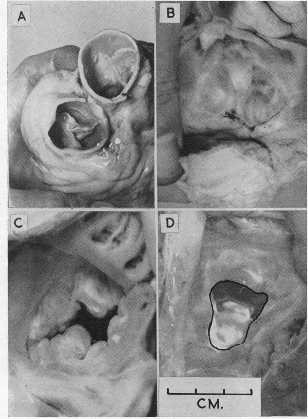 66KORNER AND SHILLINGFORD FIG. 6.-Necropsy photographs of the tricuspid valves during retrograde perfusion of the right ventricle. (A) Normal pulmonary valve. (B) Normal tricuspid valve.