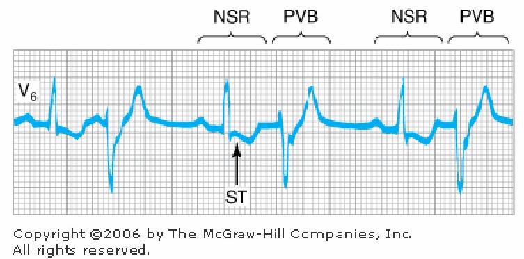 The complexes marked PVB are premature ventricular beats and are the electrocardiographic manifestations of depolarizations
