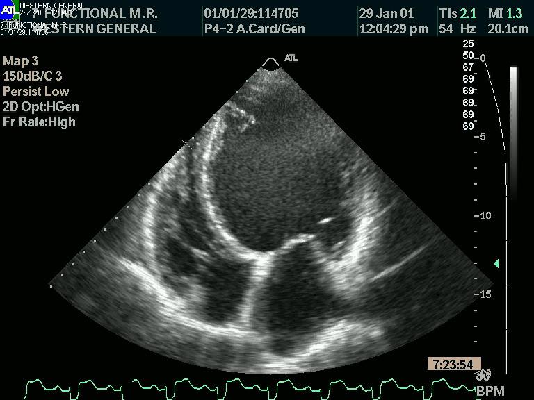 Echocardiogram Function of both