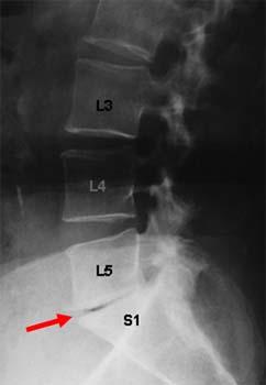 Differential Diagnosis of Radiculopathy Degenerative disc disease Pain with foraminal closing Most common at L4/5 to L5/S1 levels
