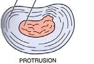 Protrusion Prolapse Increasing degree of annular