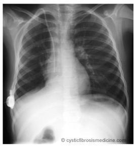 Lobar or segmental collapse in children with CF
