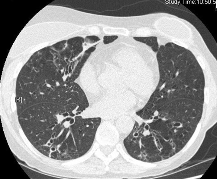 Baseline CT to study the extent of the lung involvement Every few years to examine the lungs and