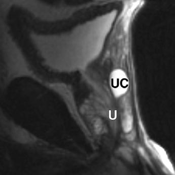 llen E, rinker D, Coppola D, Diaz JI, Epstein JI. Multilocular prostatic cystadenoma with highgrade prostatic intraepithelial neoplasia. Urology 2003; 61:644 9.