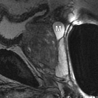 and, Transverse () and sagittal () T2-weighted MR images show