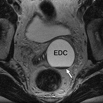 ejaculatory duct cyst (EDC) that extends from verumontanum to