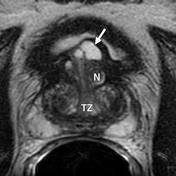 and, Sagittal () and transverse () T2-weighted images show hypertrophic
