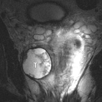 8 68-year-old man with mixed tumor of prostate containing high-grade ductal