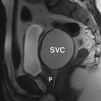 images show right seminal vesicle cyst (SVC) above