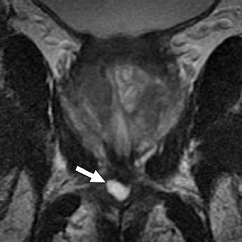 vesicle cyst (SVC). Fig.
