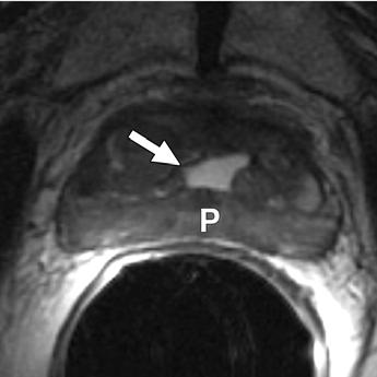 and, Cowper s duct cyst (arrows) is shown on transverse