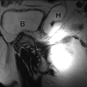 Fig. 14 61-year-old man. Transverse T2-weighted MR image shows right posterolateral urinary bladder diverticulum (D) that extends above prostate.