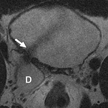 Intraprostatic Cystic Lesions 1. Müllerian duct cysts and prostatic utricle cysts 2. Ejaculatory duct cysts 3. Prostatic retention cysts 4.