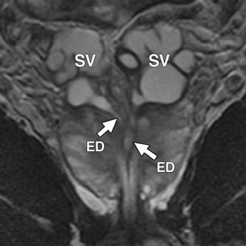 Note typical convoluted appearance of seminal vesicles and their communication with ejaculatory ducts (ED in ). 2. Cysts of the vas deferens 3.