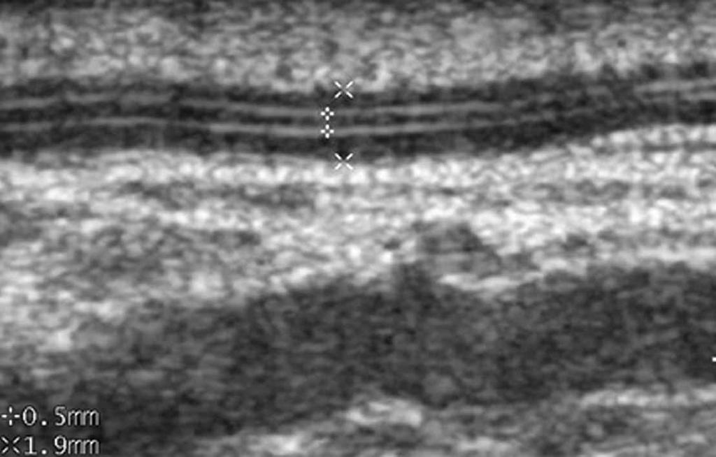 High-Resolution Sonography of the Normal Extrapelvic Vas Deferens A Figure 3. Longitudinal views of the suprascrotal vas in 2 different volunteers.