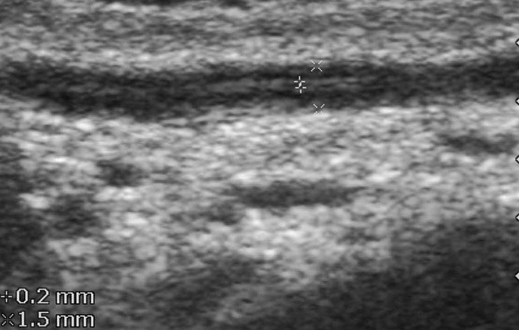 A, Sonogram from a 31-year-old man showing visualization of the vas and its lumen. The total thickness measures 1.9 mm, and the lumen measures 0.5 mm.