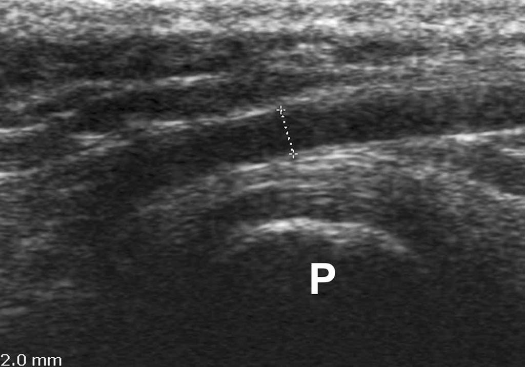 Middleton et al Provided sonography is capable of reliably detecting the normal vas, it could potentially be used to either confirm the clinical suspicion of an absent vas or establish the diagnosis