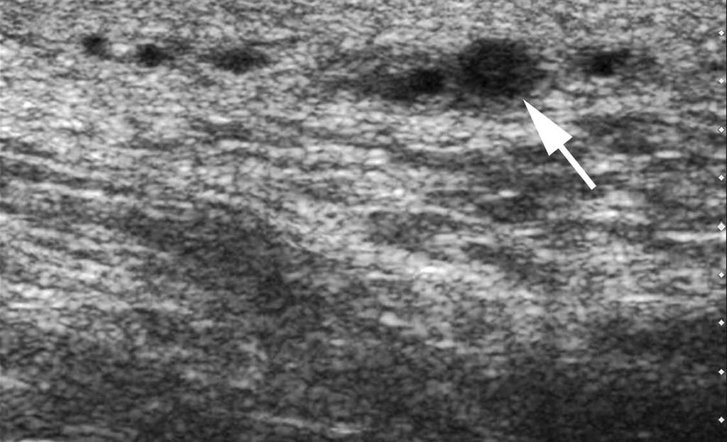 High-Resolution Sonography of the Normal Extrapelvic Vas Deferens Figure 7.
