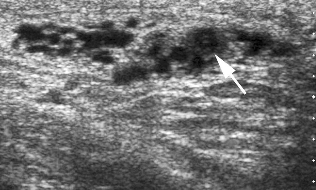 C, Color Doppler sonogram with compression showing no detectable flow in the vas (arrows) and flow in several adjacent arteries. A B C vas.