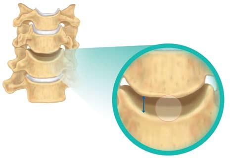 ANTERIOR CERVICAL DISCECTOMY AND FUSION Techniques Threaded Cervical Cages Discectomy is completed
