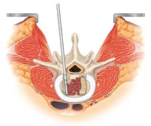 Once the disc space is prepared, the surgeon will insert allograft with autograft bone packed between and around them.