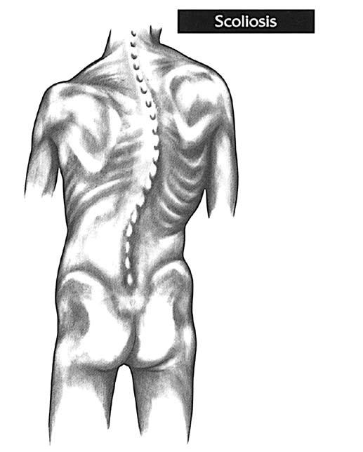 Curves of the Spine When viewed from the front or back, the normal spine is in a straight line, with each vertebra sitting directly on top of the other.