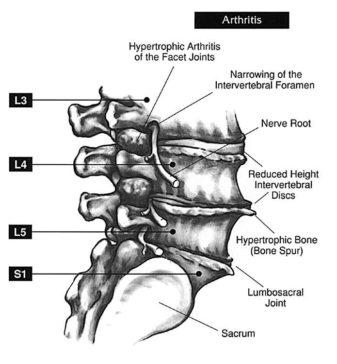 Abnormal Anatomy: Arthritis This drawing illustrates degenerative and hypertrophic arthritis between the third, fourth, and fifth lumbar vertebrae, as well as the lumbosacral joint (L5 S1 disc space).