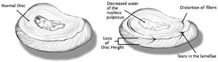 The water content of the nucleus is about 90 percent at birth and decreases to about 70 percent by the fifth decade.