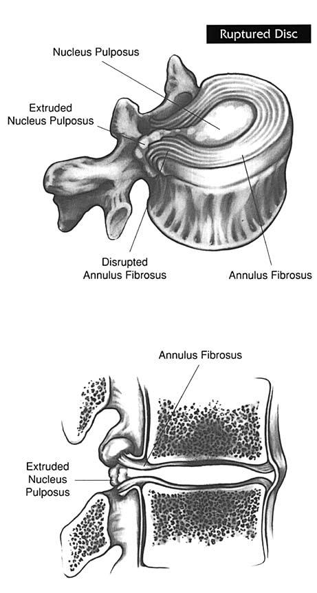 The drawings to the left and below represent the appearance of a herniated or ruptured disc.