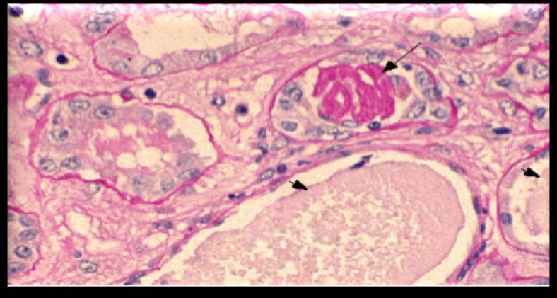 Most common pathological diagnosis on renal biopsy in multiple myeloma Cast Nephropathy Multinucleated giant cells surround the casts Due to light chains binding with Tamm-Horsfall