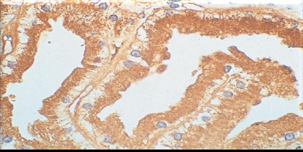 Uptake of light chains by proximal tubular cells. Renal biopsy specimen from a patient excreting κ light chains.