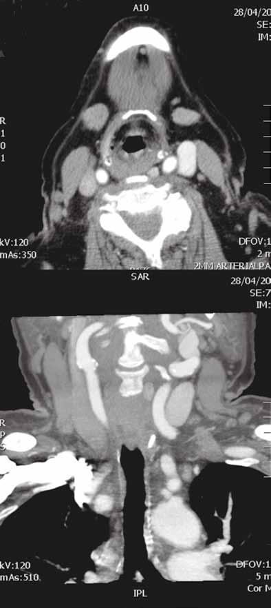 Figure 1: Parathyroid adenoma seen as hypoechoic mass with vascular rim adjacent to thyroid gland and carotid artery.