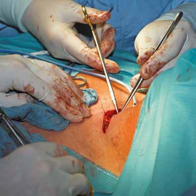 Thus, surgery is indicated in any patient with symptomatic hypercalcaemia, nephrolithiasis or previous fragility fracture.