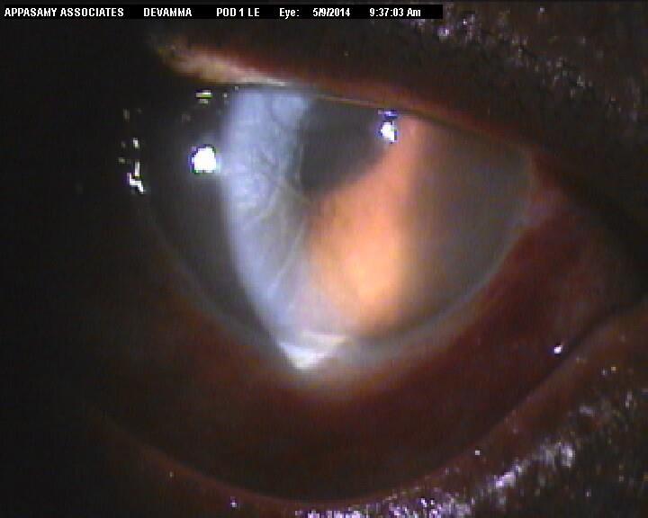 the postoperative corneal complications helps the surgeon to achieve good postoperative visual outcomes. Fig.