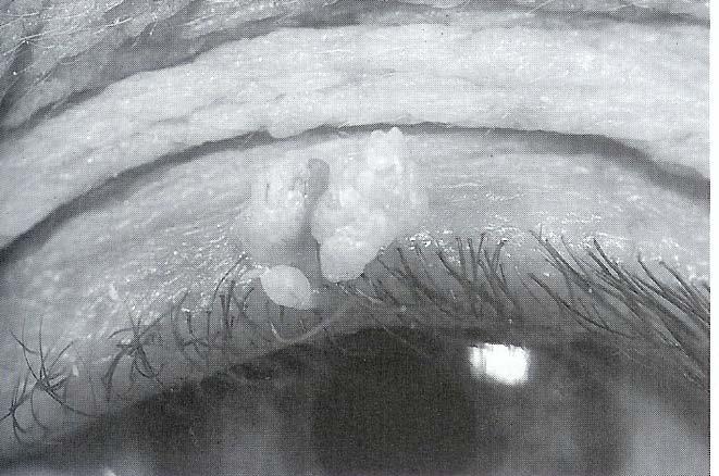 Acrochordon (fibroephithelioma, skin tag) Solitary pedunculated hyperplastic epithelium surrounding