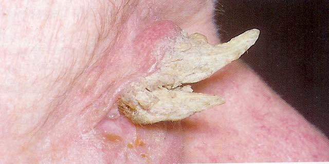 Cutaneous Horn Multiple layers of hyperkeratosis, may arise from a benign papilloma, inverted follicular