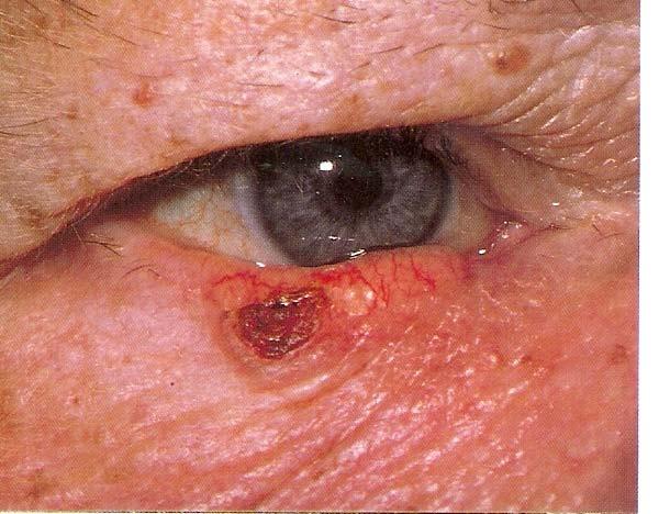 Basal Cell Carcinoma Invasive, non-metastasizing nests of basal cells Pearly borders, telangiectasia, ulceration, lash loss Commonly on lower