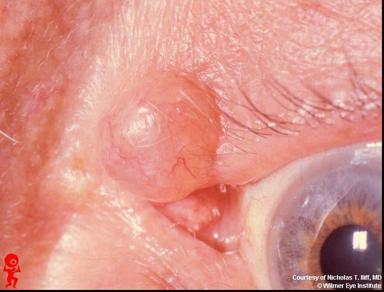 Apocrine hidrocystoma (cyst of Moll, sudoriferous cyst) Blockage of an apocrine sudoriferous gland of